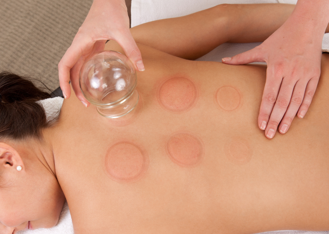 Cupping Therapy Treatment